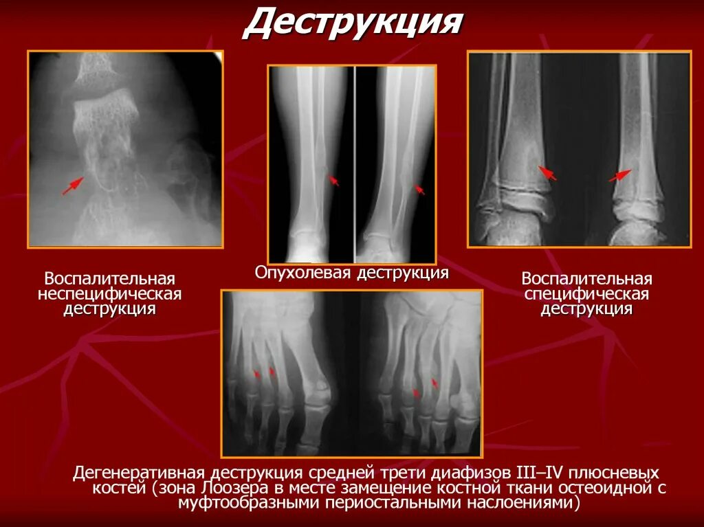 Костно деструктивные