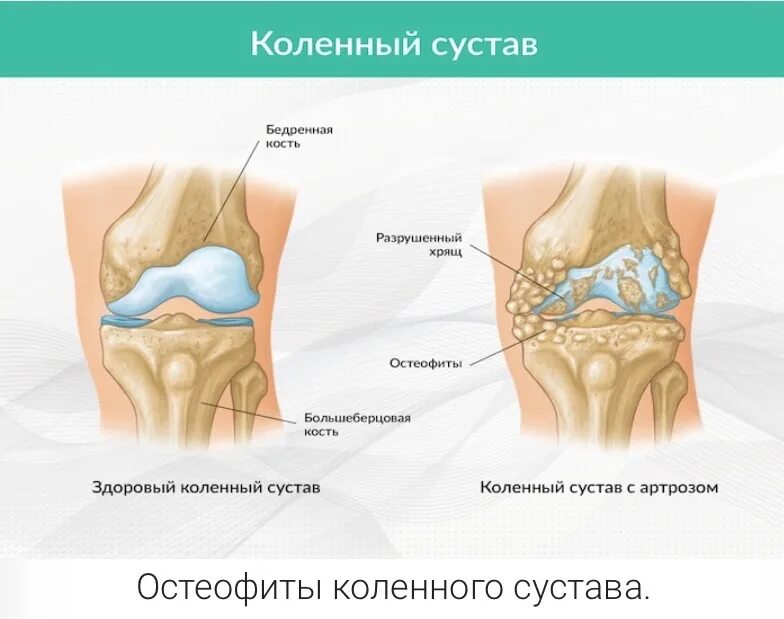 Что такое остеофиты коленного сустава как лечить. Краевые остеофиты коленного сустава рентген. остеофиты мыщелков коленного сустава. артроз большеберцовой кости. остеофиты суставных поверхностей коленного сустава.