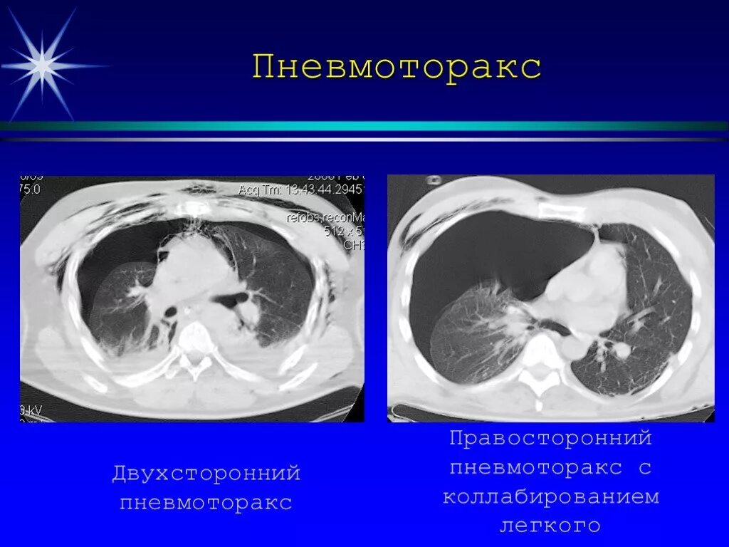 Коллабированное легкое при пневмотораксе. Напряженный пневмоторакс на кт. спонтанный пневмоторакс кт. кт при спонтанном пневмотораксе.