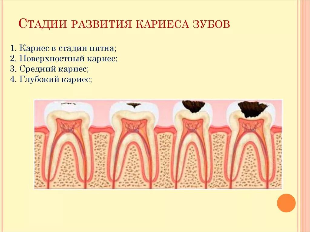 Схему формирования очаговой деминерализации эмали. Схема кариеса. Степени развития кариеса. Механизм образования кариеса биохимия. Реминерализация эмали зуба.