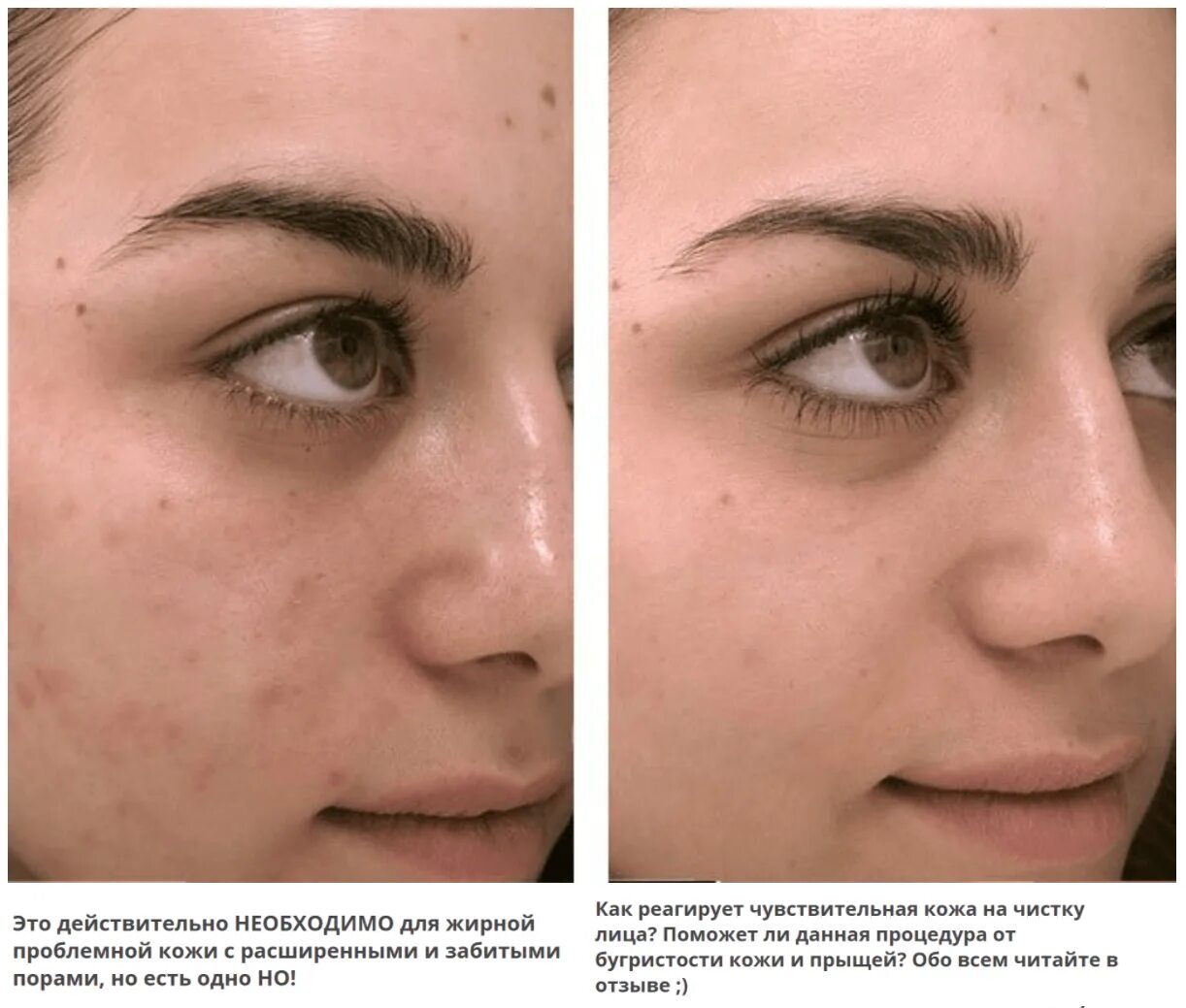 После чистки. Кожа до и после косметолога. Ультразвуковая чистка лица. Кожа до и после ультразвуковой чистки.