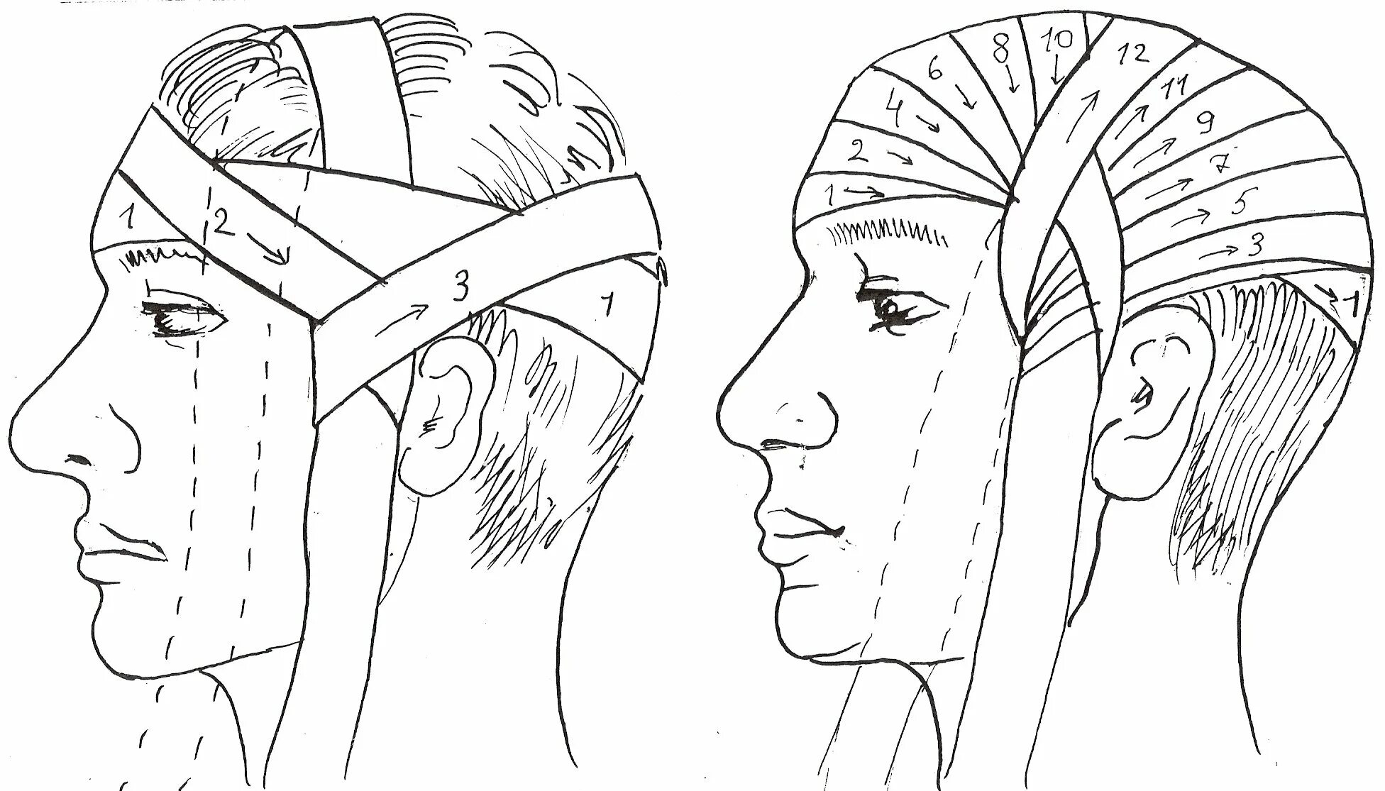 Техника наложения повязки чепец. Наложение повязки чепец алгоритм. Перевязка головы бинтом чепец. Перевязка головы бинтом чепец алгоритм. Как перевязывать голову