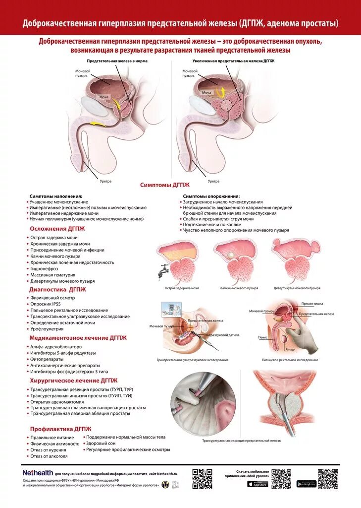 Памятка аденома предстательной железы. Памятка профилактика аденомы предстательной железы. Санбюллетень аденома предстательной железы. Аденома предстательной железы плакат. Нарушение предстательной железы