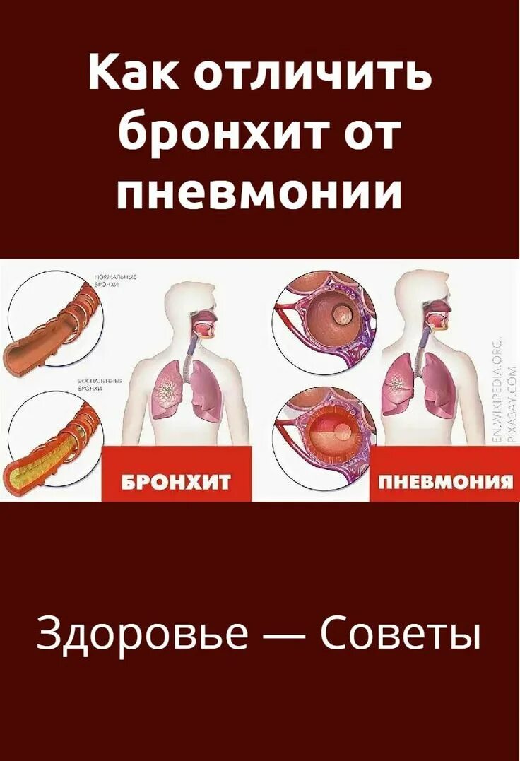 Чем отличается бронхит от. Бронхит как отличить. как распознать бронхит. бронхит от пневмонии. бронхит и пневмония отличия.