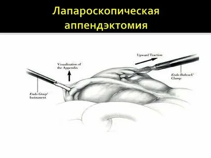 Что есть после удаления аппендицита