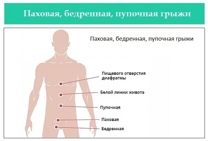 Грыжа у мужчины как болит. Пупочная грыжа психосоматика. Воспаление пупка психосоматика. Паховая грыжа психосоматика.