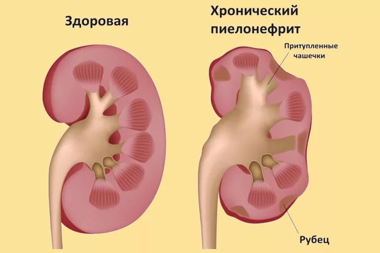 Воспаление почек заболевание. Хронический пиелонефрит макропрепарат. Острый нефрит пиелонефрит. Гнойный пиелонефрит гистология. Пиелонефрит картина почки.