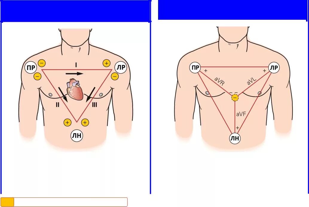 Отведения ЭКГ наложение электродов. Электроды ЭКГ схема наложения электродов. Стандарт установки электродов ЭКГ. Схема наложение электродов холтера ЭКГ. Соп экг
