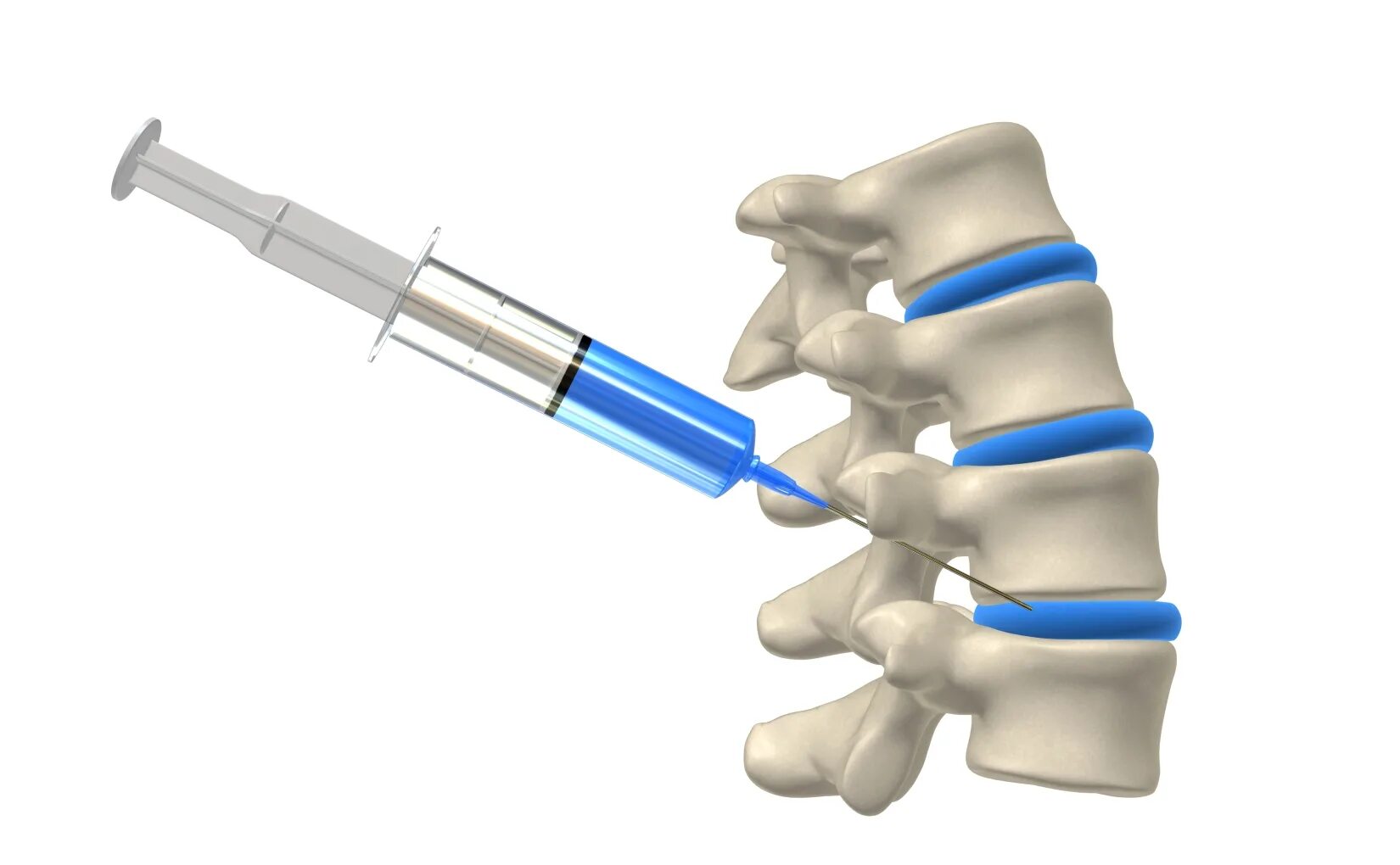 Блокада уколами поясницу. Блокада межпозвоночной грыжи поясничного отдела. Блокада позвоночника при грыже. Блокада грыжи поясничного отдела позвоночника.