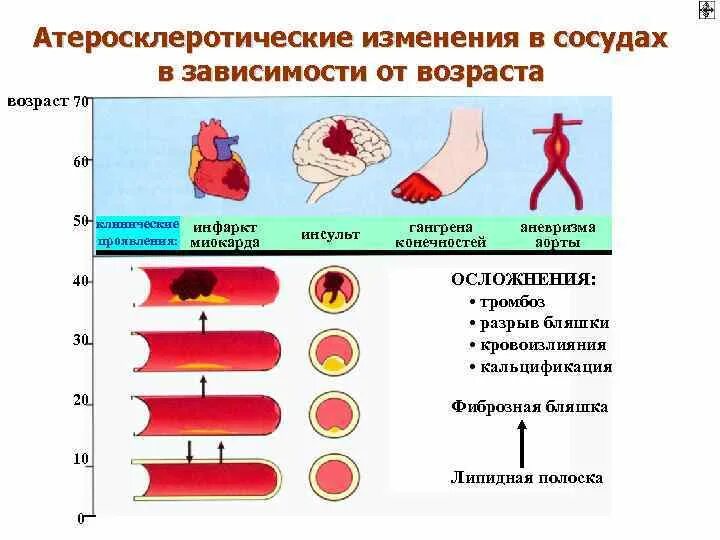 Атеросклеротические атеросклеротические поражения конечностей. Атеросклеротическое поражение сосудов. Атеросклероз сосуды по стадиям. Степень поражения сосудов атеросклероза. Атеросклероз сосудов Возраст.