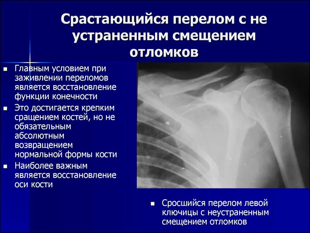 Рентген костная мозоль пере. Консолидирующийся перелом ключицы. Сросшийся перелом ключицы. Сросшийся перелом ключицы рентген. Трещина срослась