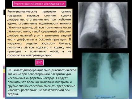 Задача с плевритом