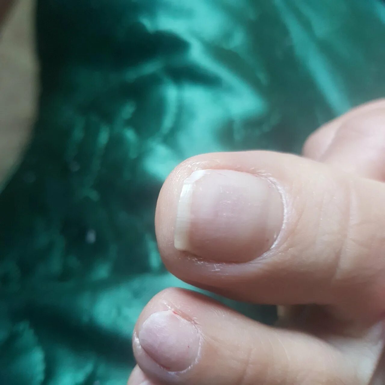 От чего синеют ногти. От чего синеют ногти