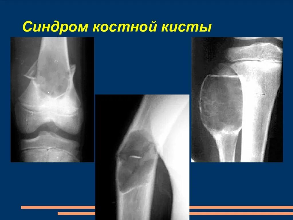 Киста большеберцовой кости рентген. Подколенная синовиальная киста что это. Субхондральные кисты. Киста коленного сустава рентген. Субхондральные кисты.