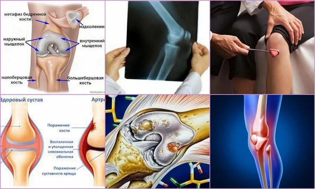 Артрит коленного сустава в домашних условиях. Периартрит гусиной лапки коленного сустава. Периартрит коленного сустава мкб 10. Симптомы периартрита коленного сустава. Воспаления коленных сухожилий (периартрита сумки «гусиной лапки»).