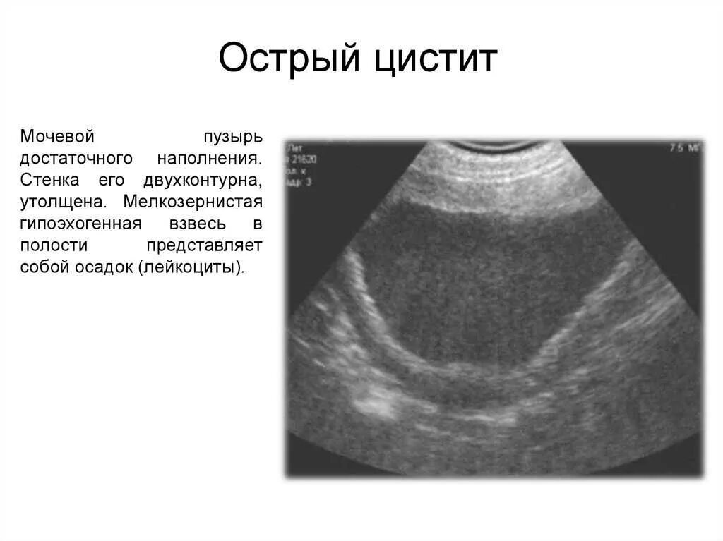 Хронический цистит на УЗИ мочевого пузыря. Острый цистит на УЗИ мочевого пузыря. УЗИ картина мочевого пузыря при остром цистите.