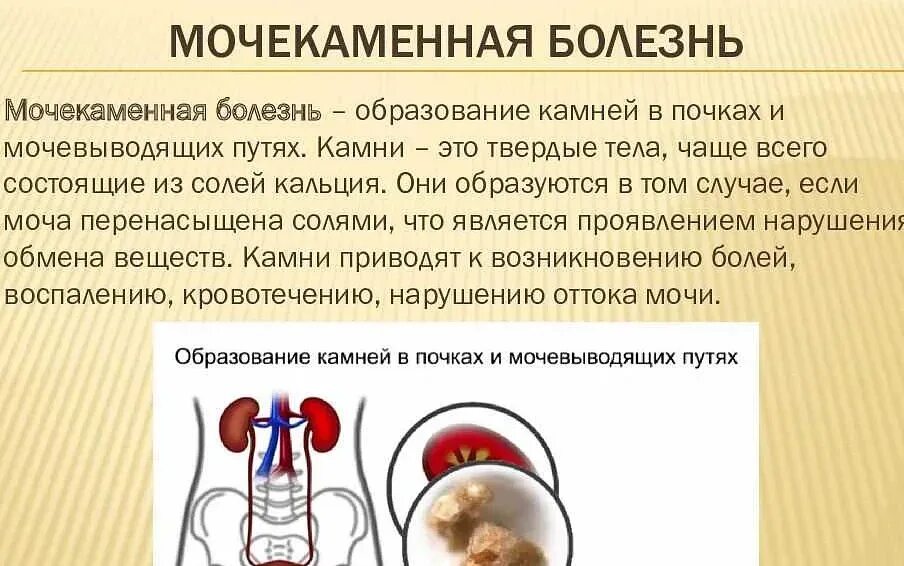 Мочекаменная болезнь причины заболевания. Моче-КАМНЕННАЯ болезнь. Мочекаменная болезнь причины. Мочекаменная болезнь причины кратко.