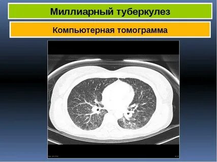 Кавернозный туберкулез кт