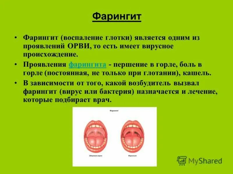 Фарингит сухой кашель лечение у взрослых