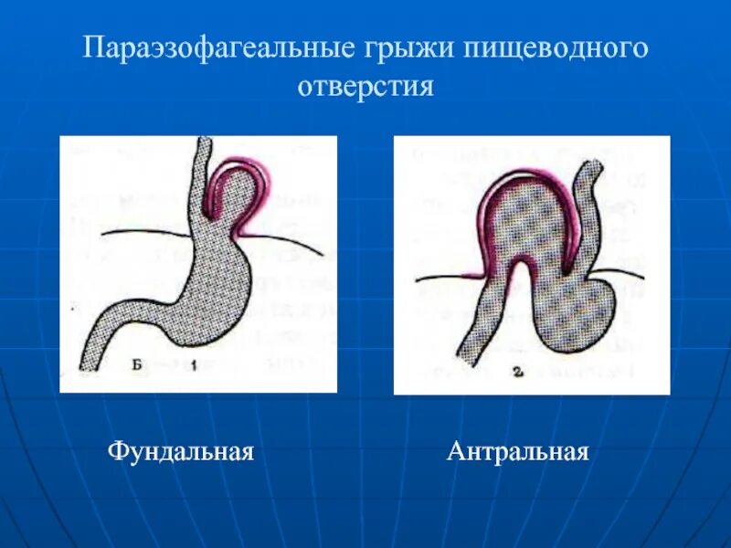 Грыжа пищеводного отверстия диафрагмы диафрагмы. Диафрагмальная эзофагеальная грыжа. Скользящая диафрагмальная грыжа. Параэзофагеальная грыжа пищеводного отверстия. Скользящая грыжа под