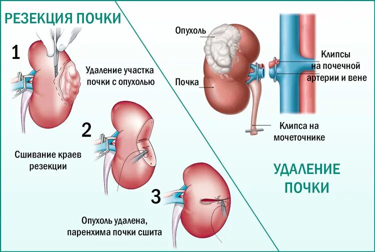 Распад почки. Операции при опухоли почки. Доброкачественная опухоль почки. Доброкачественные образования почек.