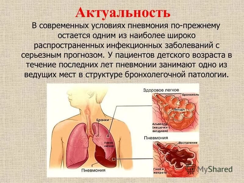 Бронхите курсовая. Пневмония презентация. Актуальность пневмонии. Презентация на тему пневмония.