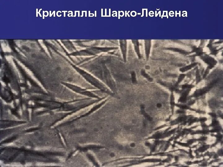 Шарко кале. Кристаллы Шарко Лейдена. Спирали Куршмана и Кристаллы Шарко-Лейдена. Спирали Шарко Лейдена. Кристаллы Шарко Лейдена и спирали Куршмана под микроскопом.