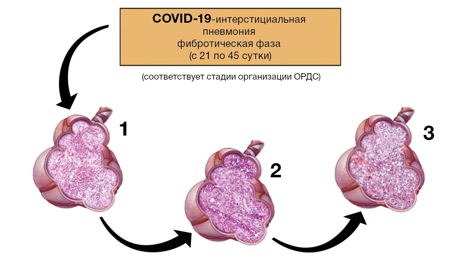 Осложнения covid. Альвеолы легких при коронавирусе. Острый респираторный дистресс. Острый респираторный дистресс синдром при Covid 19. Коронавирус альвеолы.