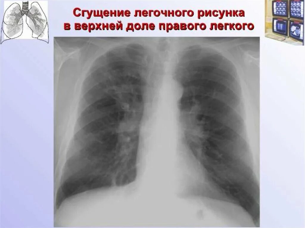 Усиленный в базальных отделах. Сгущение легочного рисунка рентген. Сгущение легочного рисунка. Легочный рисунок сгущен. Патология легочного рисунка.