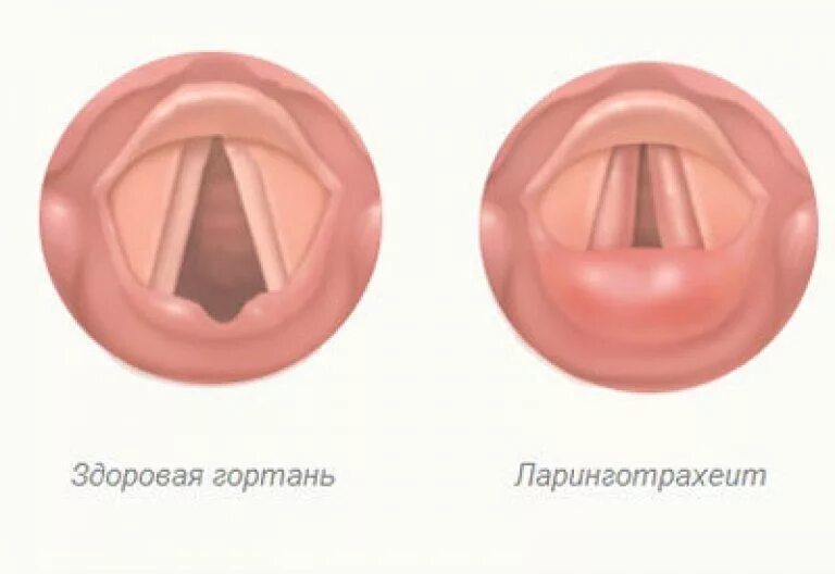 Опухают гланды миндалины что делать Лечение. Больно глотать