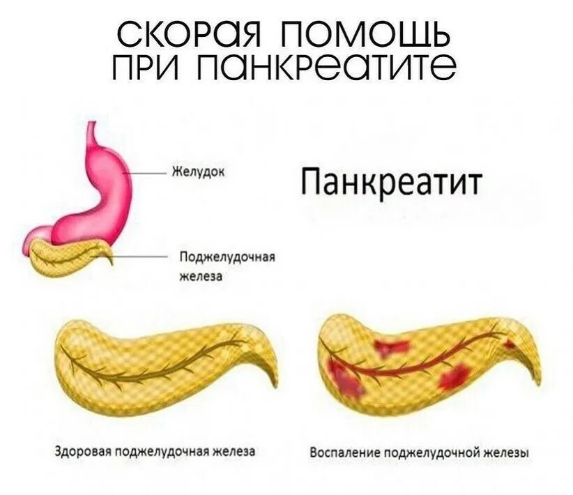 Как быстро восстановить поджелудочную. Как быстро восстановить поджелудочную