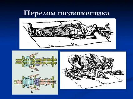 Перелом позвоночника задача