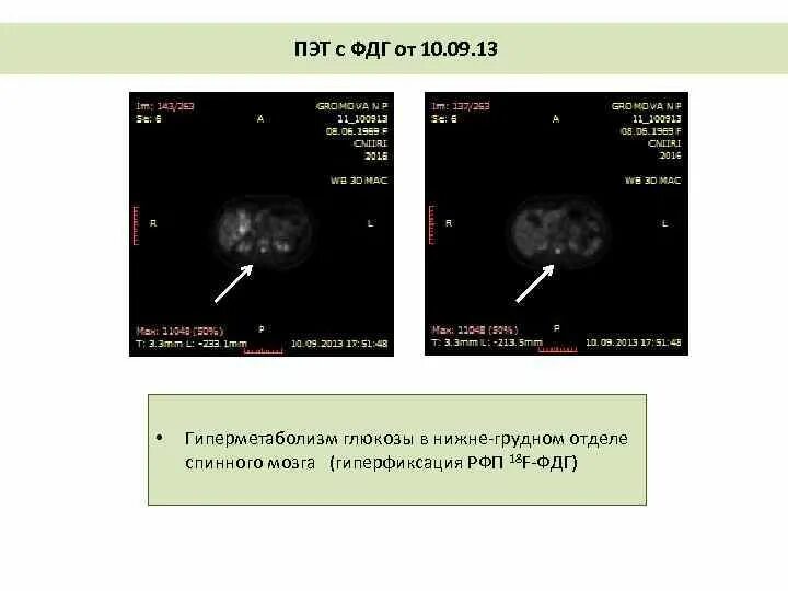 Гиперметаболизм ФДГ что это. Рфп при пэт кт