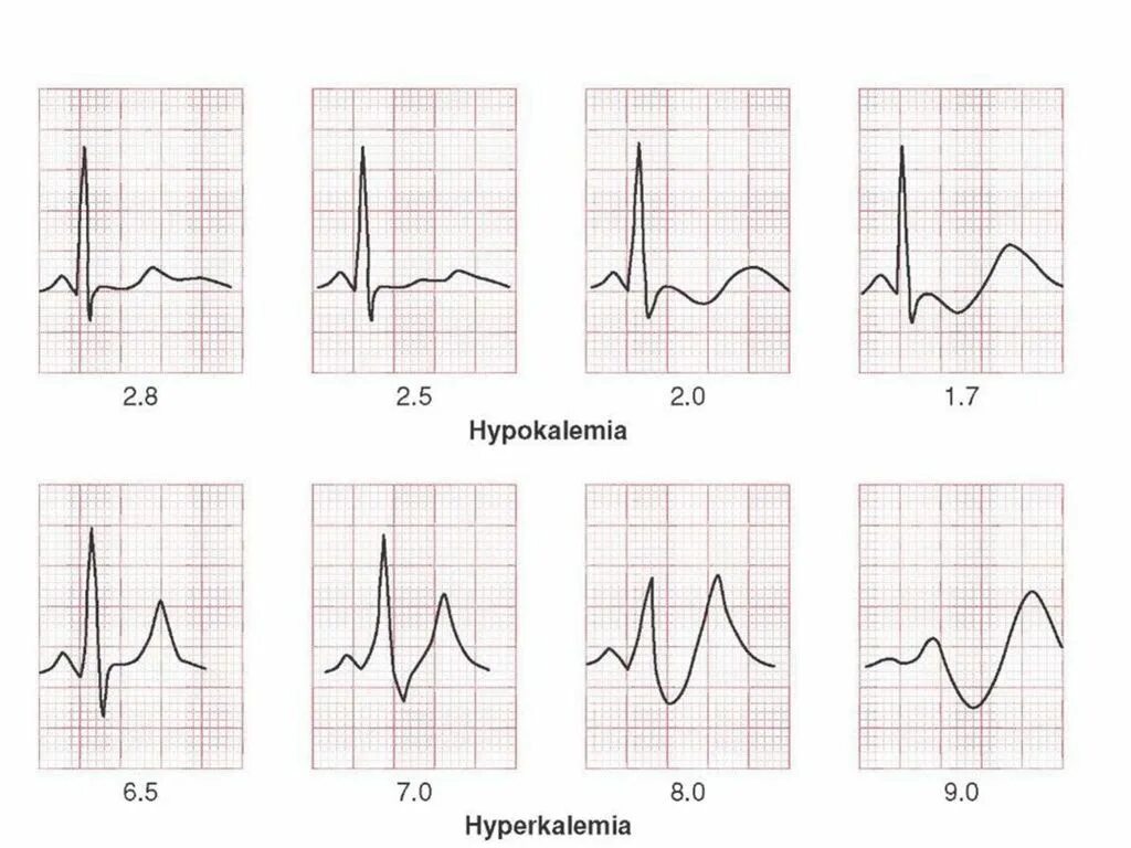 Подъем st в 3. Гипокалиемия экг зубец т. подъем сегмента st v2 v3. экг при инфаркте миокарда с подъемом st. подъем сегмента st на экг.