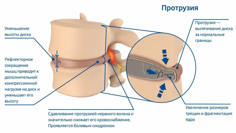 Протрузия межпозвоночного диска поясничного. Выпячивание межпозвоночного диска. Протрузия дисков. Циркулярные протрузии. Циркулярное выпячивание диска.