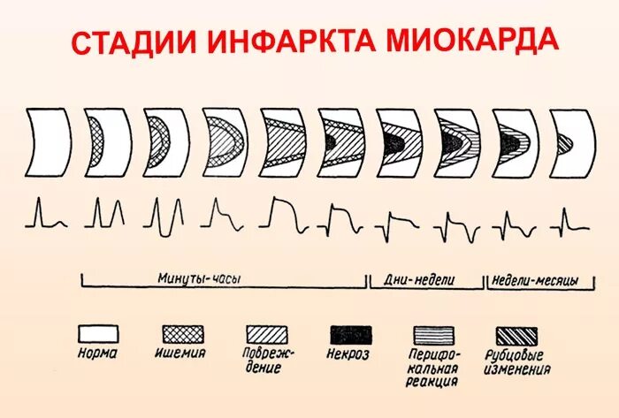 Фазы инфаркта. Этапы развития инфаркта миокарда. длительность стадий инфаркта миокарда. стадиям развития острого инфаркта миокарда. стадии острого инфаркта миокарда по времени.