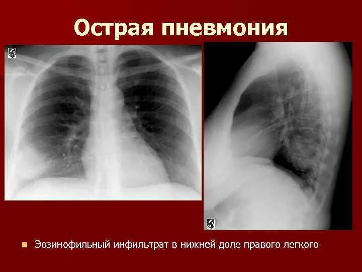Нижнедолевая пневмония справа рентген. Пневмония правой нижней доли. Пневмония правого Нижнего легкого. Пневмония в нижней доле правого легкого