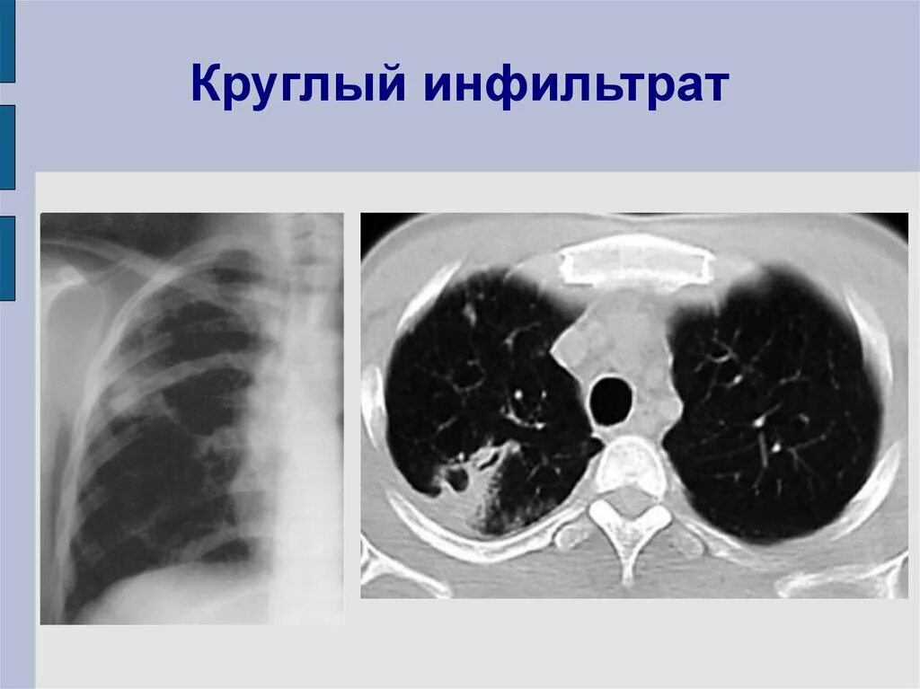 Округлый инфильтрат