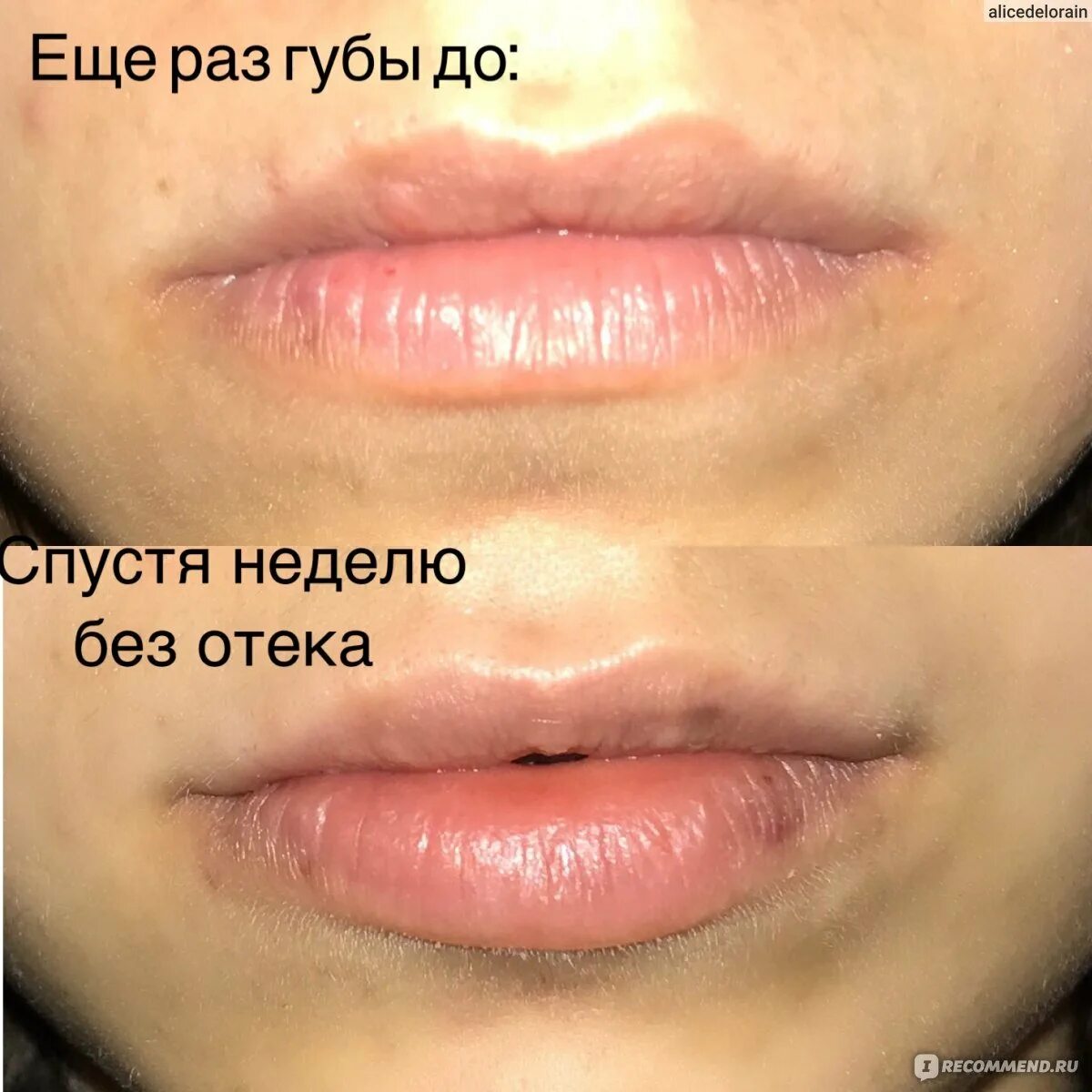 Почему утром губы. Зажившие губы 1мл гиалуронка. Накачивание губ гиалуроновой кислотой. Коррекция губ гиалуроновой кислотой.