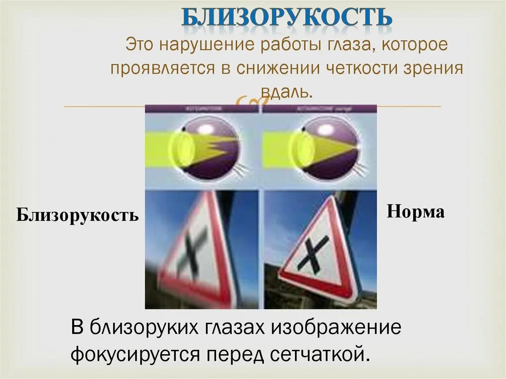 Нарушение работы глаза. Близорукость это нарушение. маркетинговая близорукость.