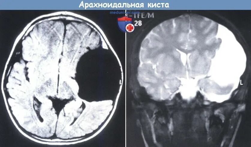 Киста в мозгах последствия. Ликворная киста головного мозга мрт. Арахноидальная киста мрт. Ретроцеребеллярная арахноидальная киста. Арахноидальная ликворная киста кт.