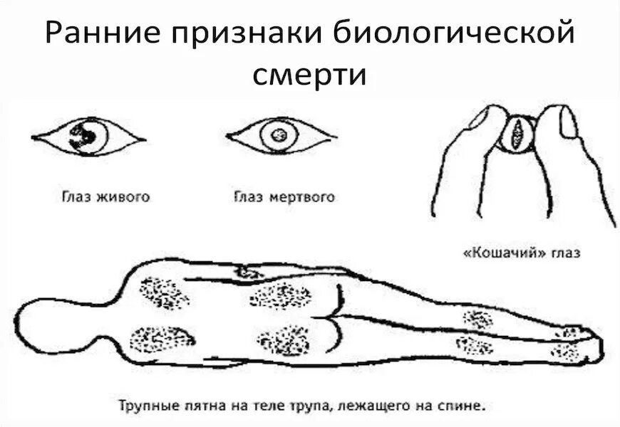 Признаки глазков. Кошачий глаз биологическая смерть. Ранние признаки биологической смерти. Симптом кошачьего зрачка при биологической смерти. Кошачий глаз признак биологической смерти.