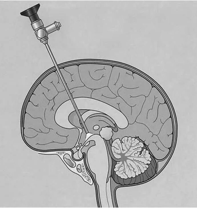 Операция гидроцефалия мозга. Эндоскопическая вентрикулостомия III желудочка. Эндоскопическая вентрикулоцистерностомия дна третьего желудочка. Стереотаксическая биопсия головного мозга. Эндоскопическая вентрикулоцистерностомия.