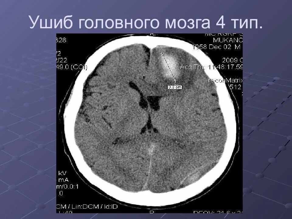 Что значит очаг в головном мозге. Ушиб головного мозга на кт 4 типа. контузионный очаг в головном мозге на кт. контузионные очаги головного мозга мрт.