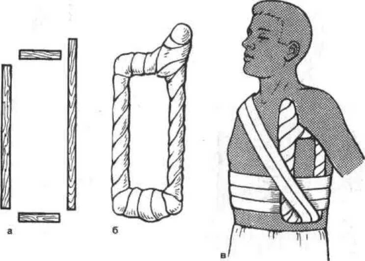 Шина для лечения переломов ключицы. Рамка Чижина при переломе ключицы. Иммобилизация Смирнова Вайнштейна. Иммобилизация при переломе ключицы повязка. Транспортная иммобилизация при переломе ключицы Дезо.