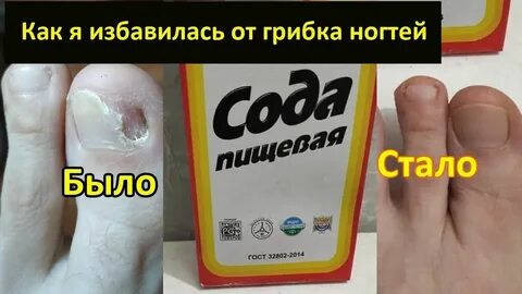 Можно вылечить грибок ногтей перекисью водорода