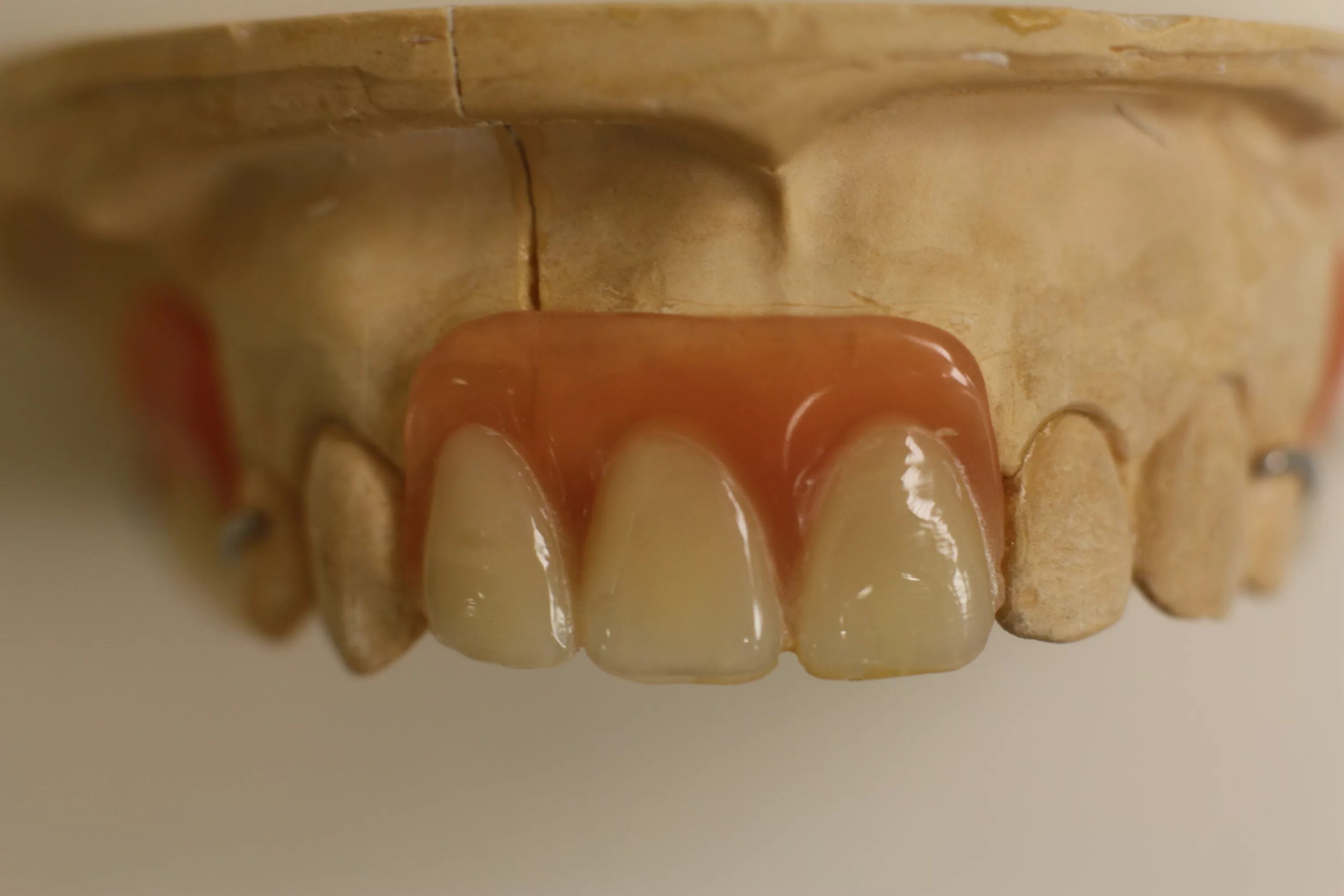 Несъемные иммедиат-протезы. Съемный микропротез «бабочка». Зубной микропротез бабочка. Бюгельный протез (1 челюсть)+кламмер. Бюгельный микропротез на 1 зуб.