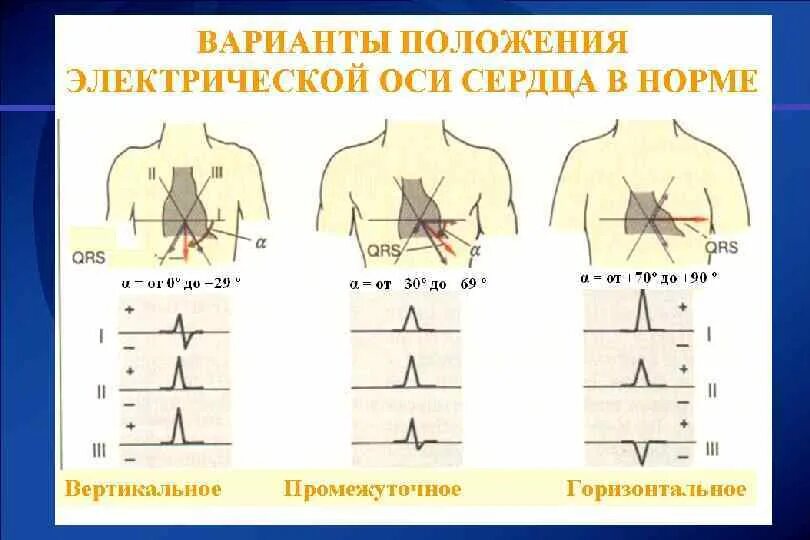 Вертикальная позиция сердца. При ЭКГ электрическая ось горизонтальная. Вертикальное положение электрической оси сердца. Положение электрической оси ЭКГ. Горизонтальная электрическая ось сердца на ЭКГ.