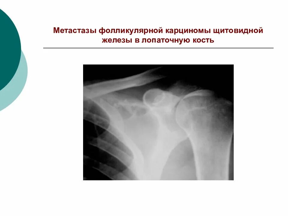 Метастазы опухоли щитовидной железы. Метастазы карциномы щитовидной железы. Метастазы в щитовидную железу. Метастазы щитовидной железы в кости.