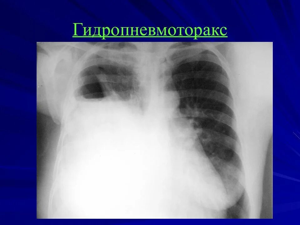 Лучевые заболевания легких. Гидропневмоторакс на рентгенограмме. Гемопневмоторакс рентген. Пневмоторакс гидроторакс гидропневмоторакс рентген. Гидропневмоторакс рентген описание.